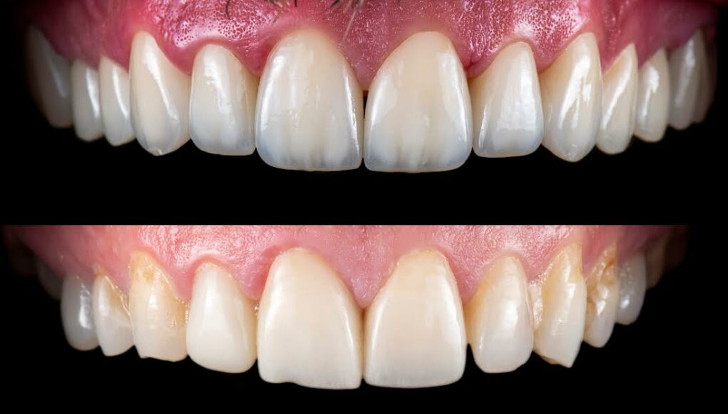 Emax ceramic crowns and veneers like natural teeth