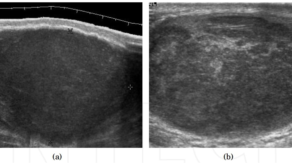 ecografia testicoli ecografia testicoli