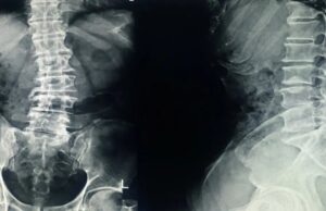 La Postura: nemico o alleato? Radiografia cervico-dorso-lo