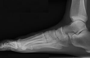 A chi serve una radiografia gamba e piede. radiologia piede