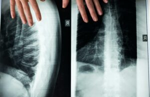Radiografia toracica e alla colonna vertebrale, perché sceglierle radiografia vertebrale